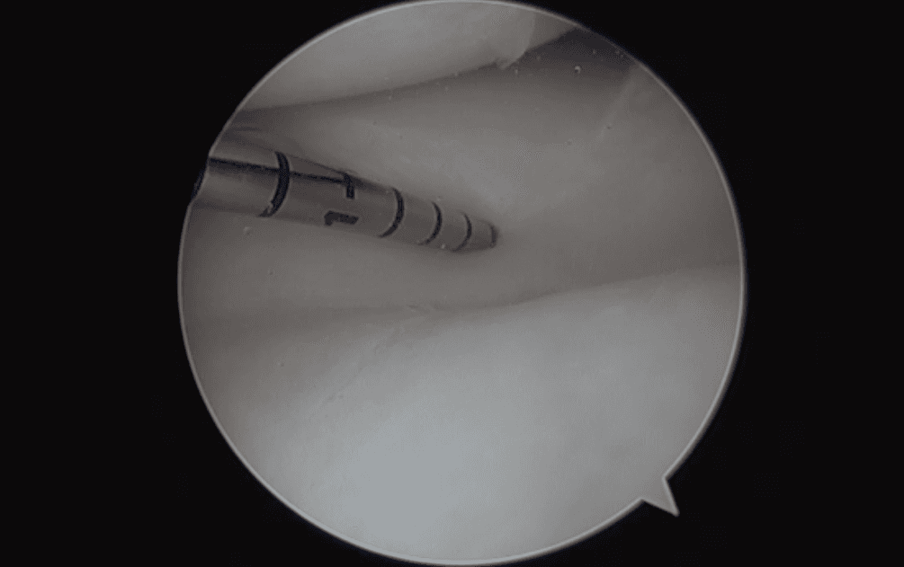Arthroscopic ACL reconstruction
