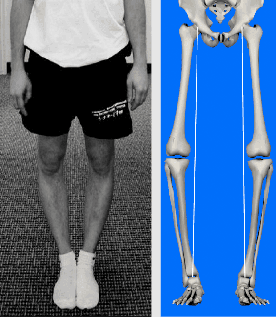 Functional alignment plan for knee replacement