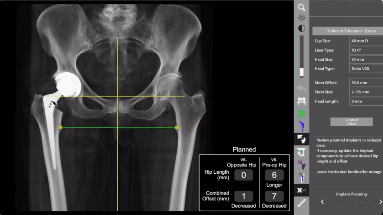 3D planning for hip replacement using the Mako robotic-arm system