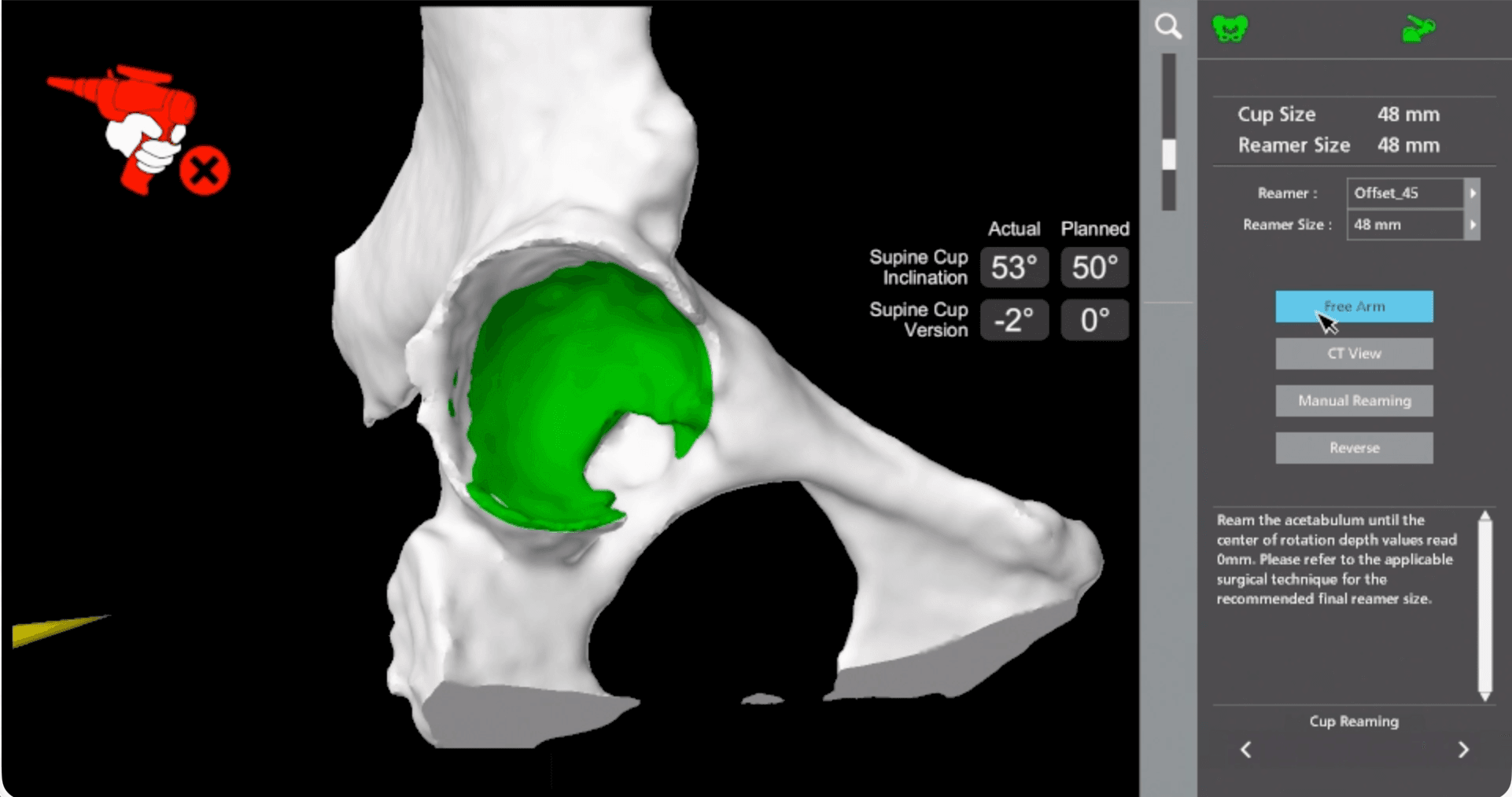 Robotic-assisted planning of the acetabular socket position for hip replacement