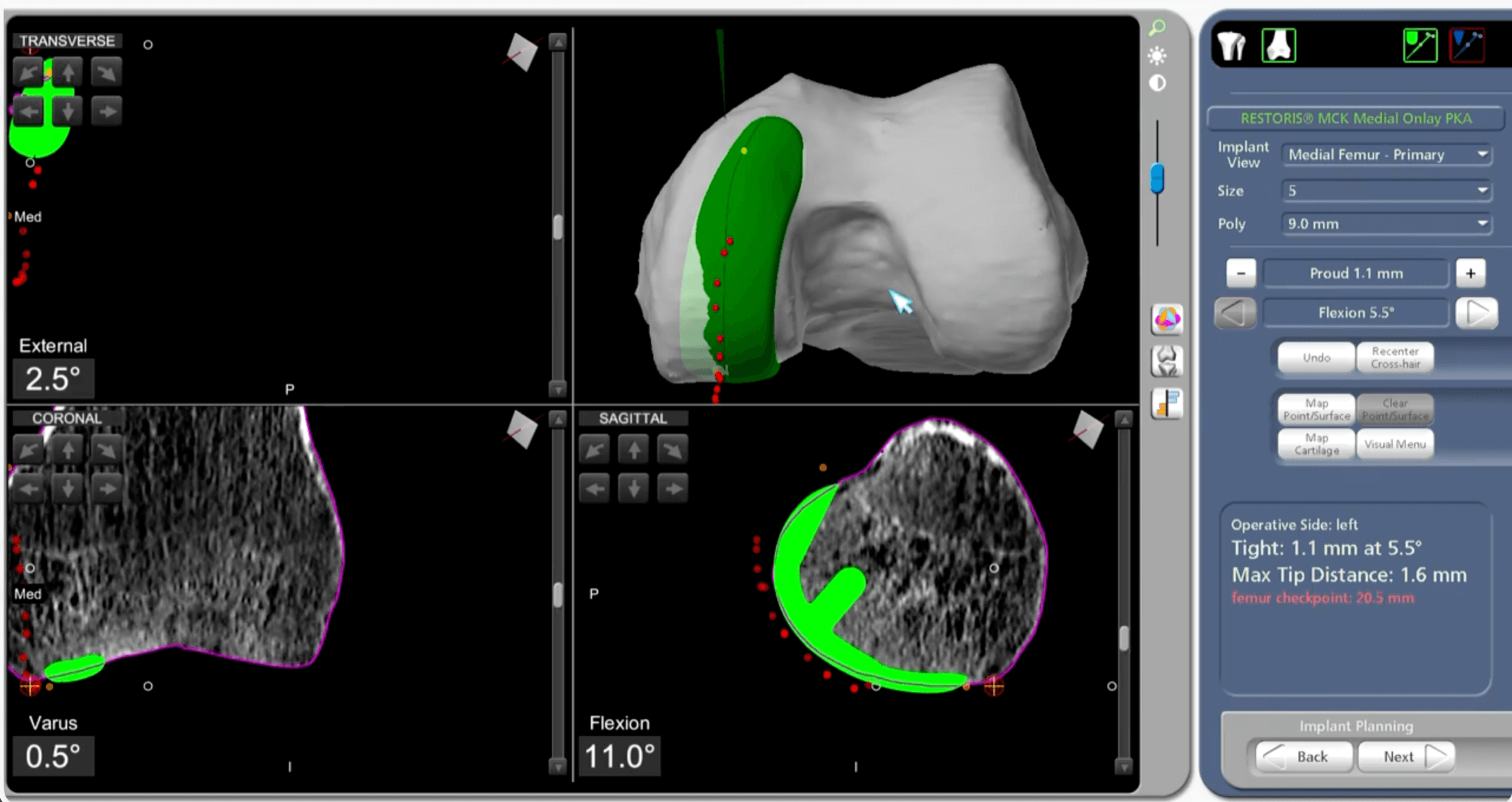 Mako CT-based 3D plan for total knee replacement